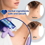 Wart Removing Pen-1 Pcs